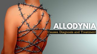 Living with Allodynia Tips for Coping and Alleviating Unbearable Pain [upl. by Noloc]