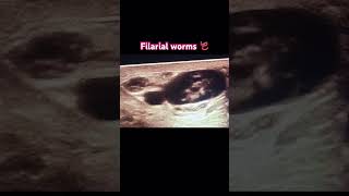 Filarial worms radiology ultrasonography medicine clinical [upl. by Eevets]