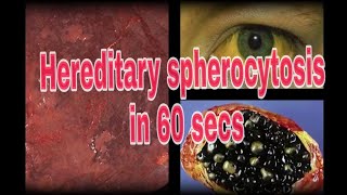 Hereditary Spherocytosis  A 60 sec Pathology lecture [upl. by Notreve]