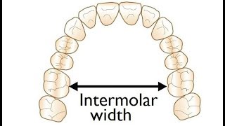 Measurement of Intermolar Width on a Model for Orthodontic Treatment by Dr Mike Mew [upl. by Thibaut81]