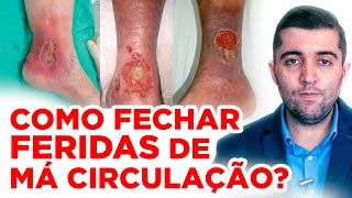 Como acabar com úlcerasferidas da má circulação curativo antibiótico diagnóstico e cicatrização [upl. by Triley]