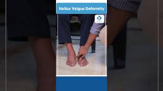 Hallux Valgus Deformity  Causes  Symptoms  Treatment  Foot Pain  Dr Vamshis Orthopaedic Center [upl. by Ssidnac]