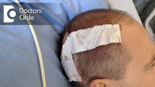 What are the risks in a Craniotomy  Dr Bopanna K M [upl. by Leidba206]