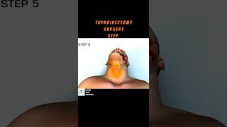 THYROIDECTOMY SURGERY STEPs thyroid thyroidsurgeryshorts [upl. by Bryan]