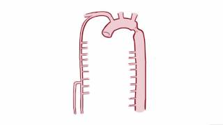 A case of coarctation of the aorta ECGecho and treatment [upl. by Nrek]