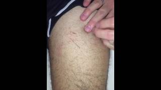 Dry Needling [upl. by Alexio]