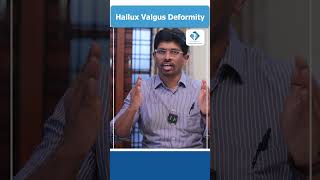 Hallux Valgus Deformity  Causes  Symptoms  Treatment  Foot Pain  Dr Vamshis Orthopaedic Center [upl. by Evetta932]