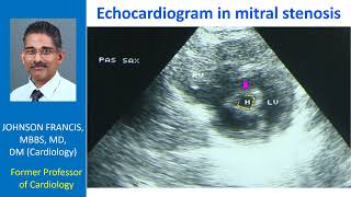 Echocardiogram in mitral stenosis [upl. by Jezabelle590]