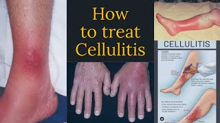 iv antibiotics for cellulitis [upl. by Bradleigh]