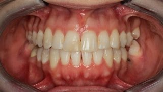 Invisalign Time Lapse [upl. by Gadmann]