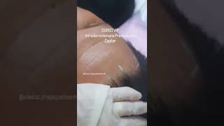 Curso Vip de Intradermoterapia Pressurizada  Tratamento Capilar estetica esteticista beleza [upl. by Pierette142]