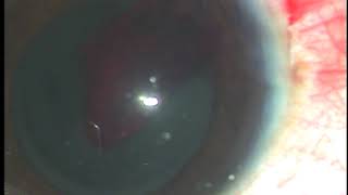 Surgical management of Hyphema  Dr Pradip Mohanta MS Ophth [upl. by Annoit309]