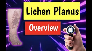 Lichen planus causes treatment diagnosis management [upl. by Anitsirhk]