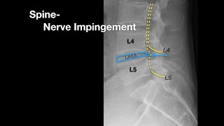 Spine Nerve Impingement [upl. by Aerdnuahs]