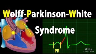 WolffParkinsonWhite Syndrome Pathophysiology PreExcitation and AVRT Animation [upl. by Ozen]