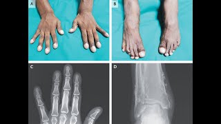 Primäre hypertrophe Osteoarthropathie [upl. by Tnias]