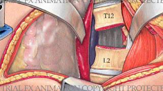 Lumbar Corpectomy and Fusion with Synthes Synex II Device [upl. by Maridel310]