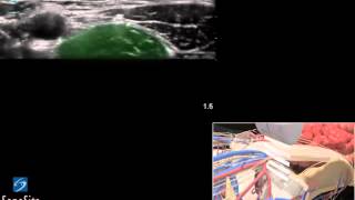 3D Lehrvideo Ultraschallgestützte femorale regionale Nervenblockade  SonoSite Ultraschall [upl. by Ashely]