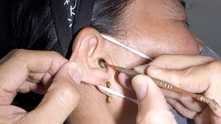 Removing Womans Hard Earwax Blockage [upl. by Paulina460]