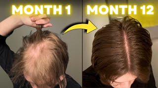 FINASTERIDE Stopped My Hair Loss in 1 YEAR [upl. by Colp]