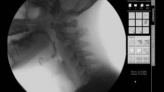 Swallow Study  13 mm Barium TabletPill  Modified Barium Swallow Study MBSS Lateral View HD [upl. by Nooj207]