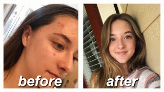 ACCUTANE FOR MILD ACNE  my story amp monthly updates [upl. by Aerdua]