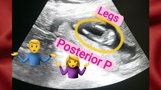 13 weeks oregnant gender reveal  posterior placenta means baby boygirl  how to tell gender on usg [upl. by Foushee868]