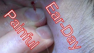 Painful Ear Cyst Explosion  Life With Cystic Acne Documentary 22 [upl. by Farand284]