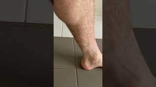 These Calf Muscle Twitches Cramps and Spasms Look Like Little Earthquakes Under the Skin [upl. by Anyrak884]