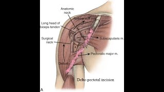 Proximal Humerus Fracture Open Reduction and Internal Fixation [upl. by Welby]