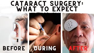 What To Expect Before During And After Cataract Surgery [upl. by Wootan625]