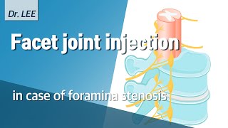 Facet joint injection in case of foramina stenosis technique and my logic lumbar spine [upl. by Eam]