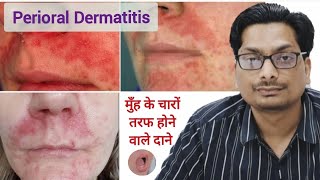 मुँह के चारों तरफ होने वाले दाने  Perioral Dermatitis  Red rash around mouth  Skin rash mouth [upl. by Onin21]