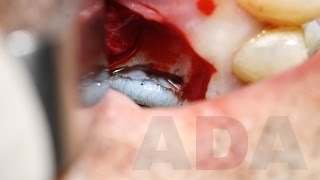 Reendodoncia y Resección Radicular [upl. by Analim278]