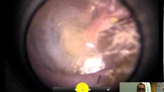 normal ear exam of the tympanic membrane [upl. by Clarkin]