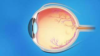 Trabecular Bypass Stent for Glaucoma [upl. by Sugna]