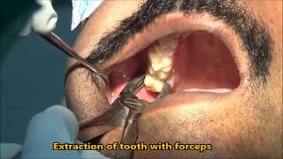 Upper wisdom tooth extraction with forceps [upl. by Anoyk689]