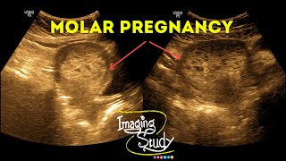 Molar Pregnancy  Hydatidiform Mole  Gestational Trophoblastic Disease  Ultrasound  Case 38 [upl. by Latrice]