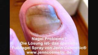 Nagel Problem Fußnägel brüchig Fußnägel Querrillen [upl. by Okorih647]