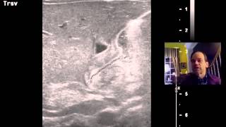 Pyloric Stenosis Ultrasound DISCUSSION 1 [upl. by Ecydnak]