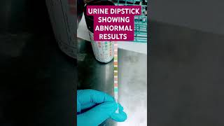 Abnormal Urinalysis Urine Color CloudyYellow Blood 3 Nitrite positive Leukocyte 3 protein 1 [upl. by Patti]