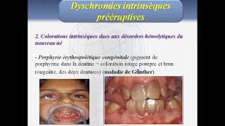 Cours Odontologie Conservatrice et Endodontie Deuxième Année Médecine Dentaire Partie 3 [upl. by Lanor95]