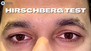 Hirschberg Test [upl. by Given943]