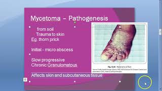 Microbiology 578 a Mycetoma foot Madurella mycetomatis Maduramycosis mycosis Eumycetoma Welsh regime [upl. by Hume]