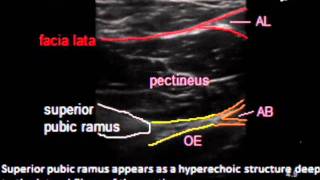 Obturator nerve block  A new USguided proximal interfascial technique [upl. by Enoryt]