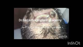 Demonstration on implant placement and CBCT evaluation [upl. by Yerahcaz]