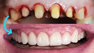 Prepless porcelain dental veneers Cosmetic dentistry Before and after to fix gap [upl. by Orvas]