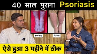 Psoriasis Treatment In Hindi Ft upasanakiduniya  Skin Disease  Himanshu Bhatt [upl. by Adyela]