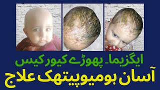 Cure Case  Eczema  Abscesses  ہومیویتھک علاج [upl. by Nylirehs]