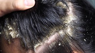 Dandruff scratching removal on head using black combing229 [upl. by Nytsua]